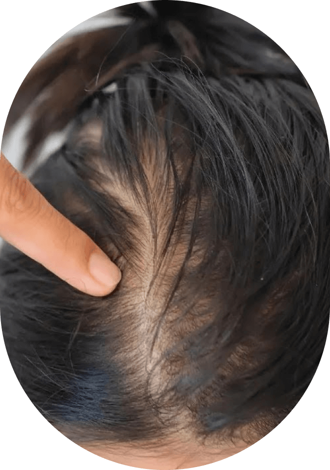 Hair Loss