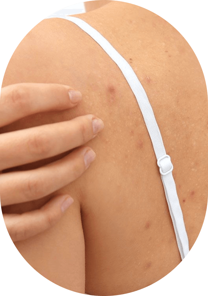 Body Acne