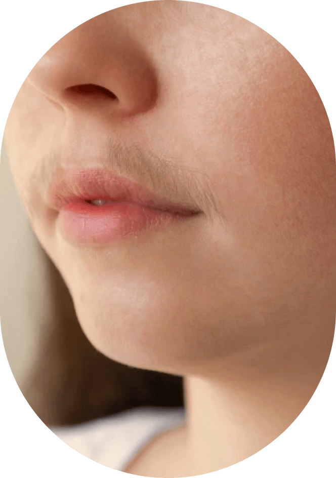 Excessive Facial Hair