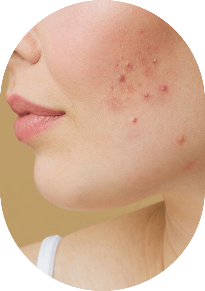 Facial Acne