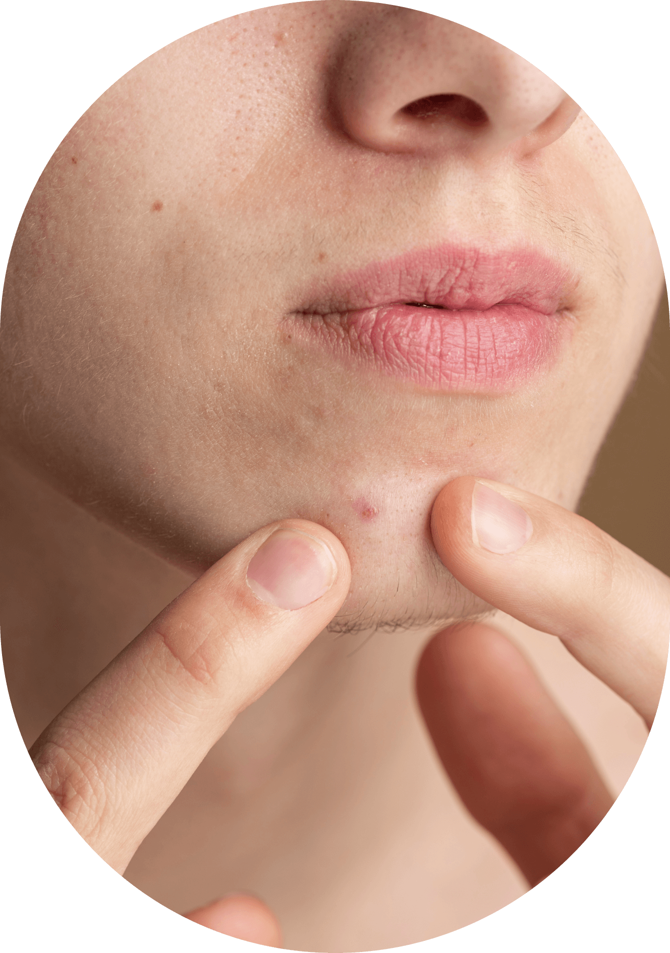 Acne Flare-Ups